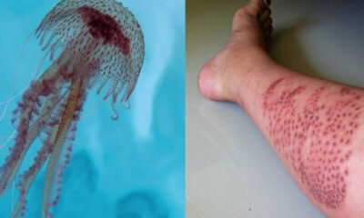 How do you Treat a Jellyfish Bite?